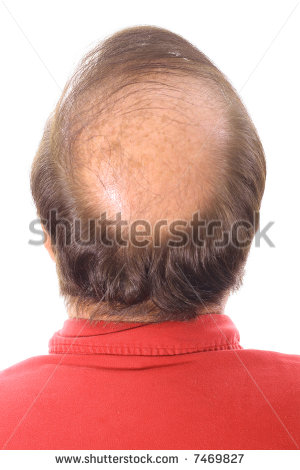 tips to regrow lost hair naturally